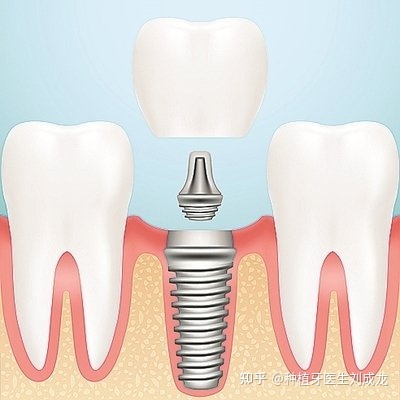 郑州种植牙医生刘成龙:上颌磨牙区单颗种植案例