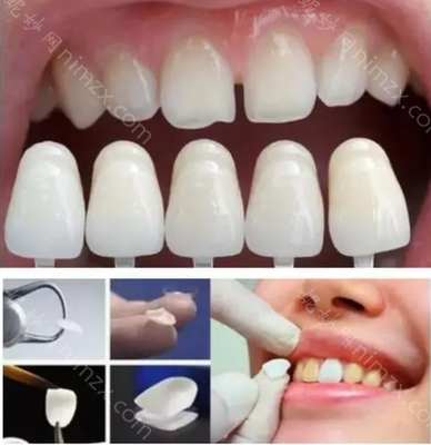 郑州康美牙科诊所多少钱?种植牙矫正和修复费用是多少?