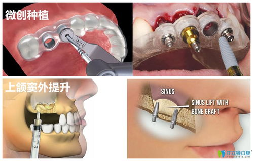 意外险里种植牙保吗 无忧保综合意外险