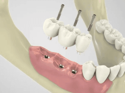 2022郑州种植牙怎么报销?是否可以报销?