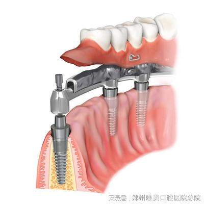 郑州种植牙|做种植牙后,就不能做核磁共振了吗?