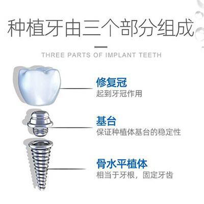 郑州市种牙价格是多少?揭秘郑州种植牙大概多少钱一颗!