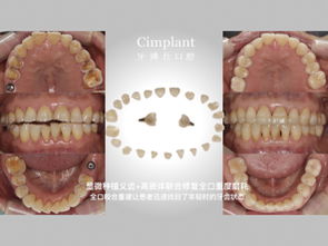 郑州种植牙价格是多少