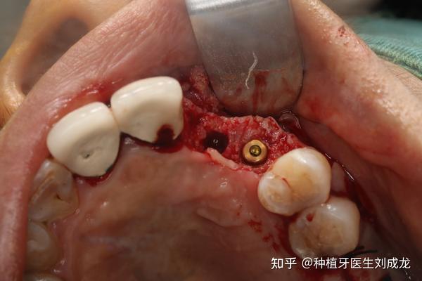 郑州种植牙医生刘成龙:即拔即种多颗种植案例