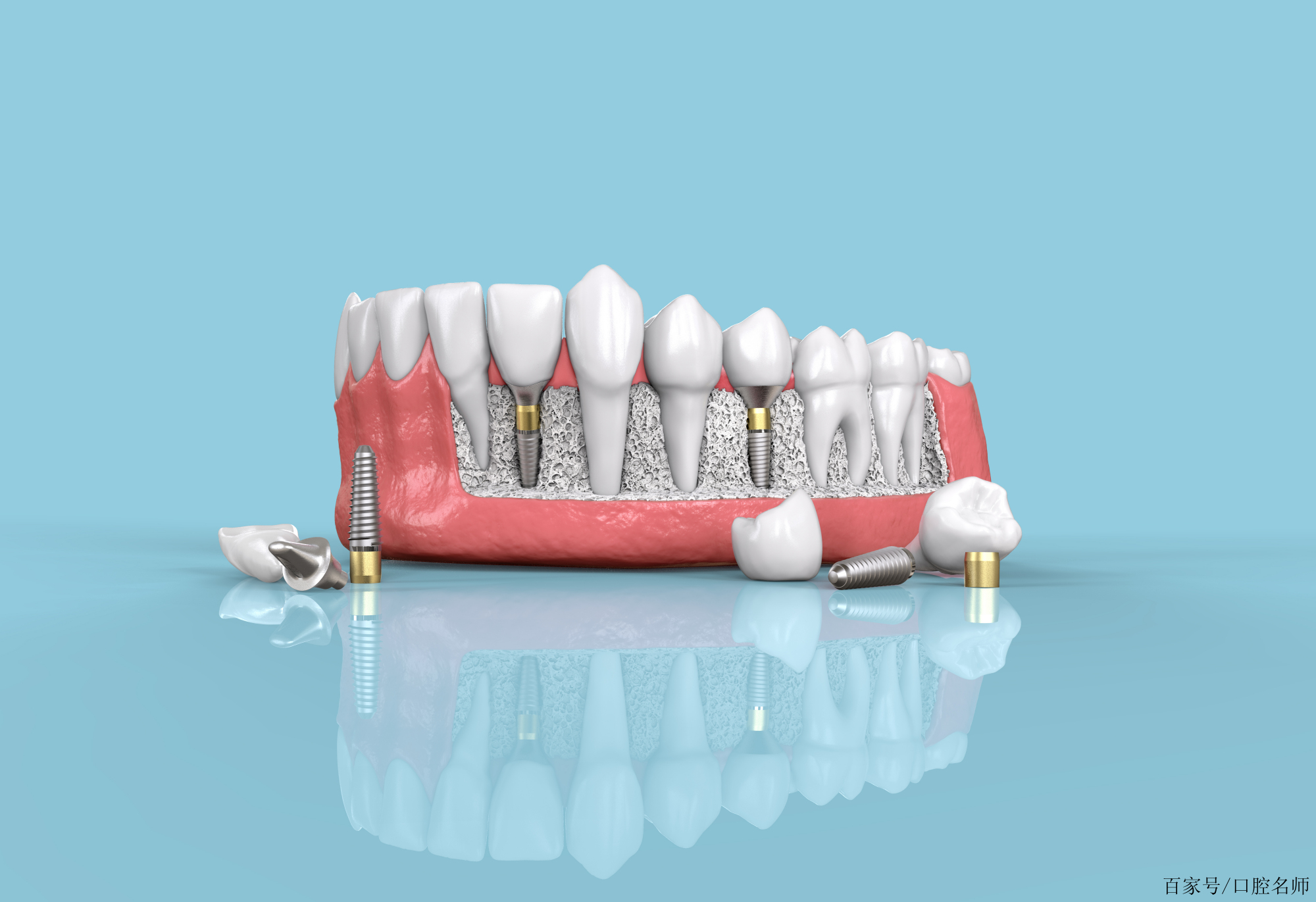 郑州瑞士iti种植牙费用多少? - 