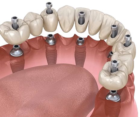 老年人缺牙怎么办?植得口腔李斌来支招!|郑州植得口腔|种植牙|手术|牙