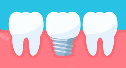 想知道郑州种植牙哪家比较好?植得中诺唯美都中!