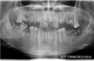 郑州种全口/半口All-on-4种植牙是啥体验?有好的医生推荐没?