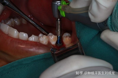 郑州瑞士ITI种植牙医生刘成龙:上颌磨牙区单颗种植案例