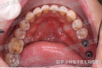 多颗种植牙(郑州)分享