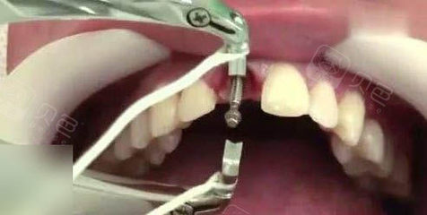 郑州种植牙费用一般是多少?三千起步!种植体品牌和型号对总价格影响非常大~以到院了解为主