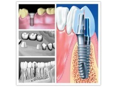 郑州做种植牙哪家的医院好_中国贸易网