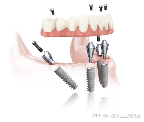 半口 全口即刻种植即刻负载是咋回事 有种诺贝尔种植牙技术好的郑州医生推荐
