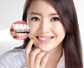 美呀隐形矫正,做懂职场白领的正畸产品