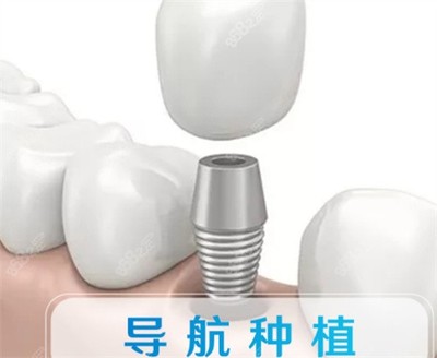 郑州固乐口腔数字化种植牙技术高,种一颗牙才4000元起