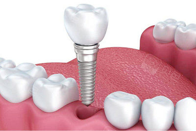2025郑州种植牙价格新规:国产2980元起,瑞士ITI低至9800元,附半口全口报价