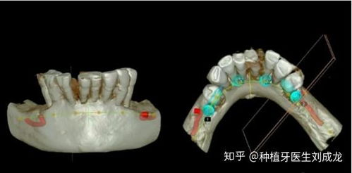 在郑州种瑞士iti瑞锆种植牙好吗 可有副主任医师或主任医师推荐