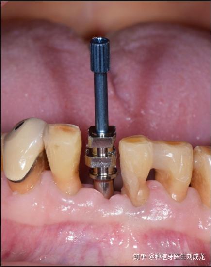 郑州种植牙:哪家医院做种植牙好? - 