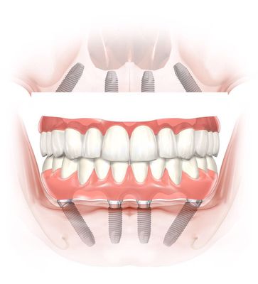 郑州无牙颌,可以做全口/半口种植牙吗?找副主任医师或主任医师做,是不是更有保障?