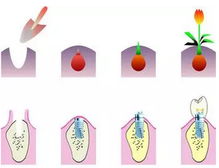 种植牙 为什么这么贵