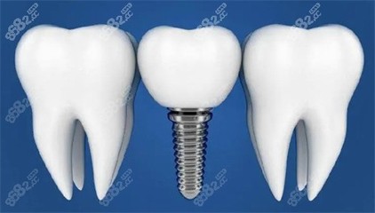 2023年种植牙价格全面下调 郑州等地迎来惠民新政