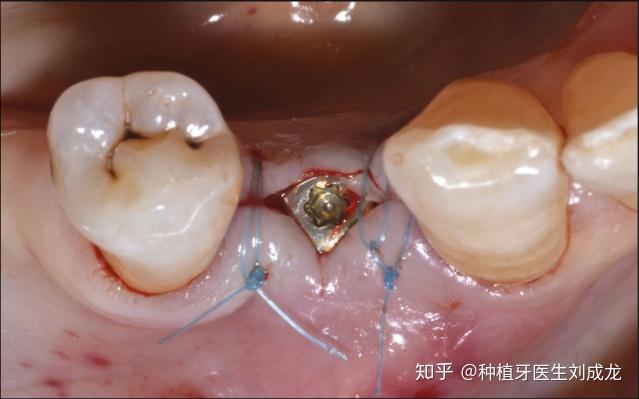 郑州瑞士ITI亲水种植牙体验：主任医师亲诊，重塑您的灿烂笑容