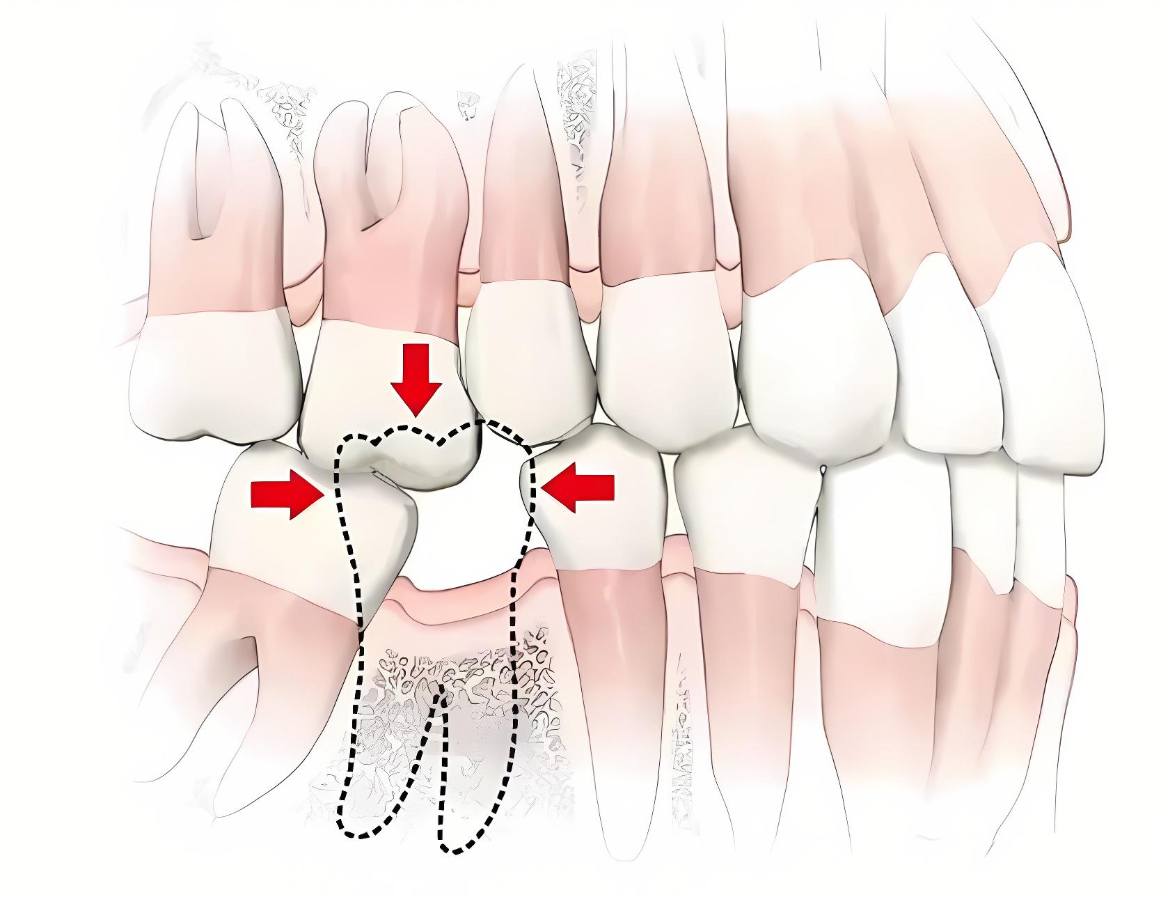 郑州种植牙治疗时间详解 从评估到完成需要多久？