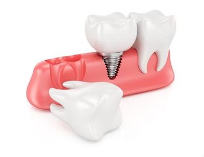 郑州泰康百博种植牙费用优势解析 集中采购后韩国登腾种植牙起价2280元