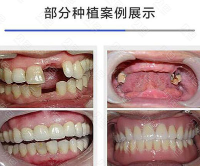 郑州种植牙医院排行前十 用户口碑认可的专业牙科推荐