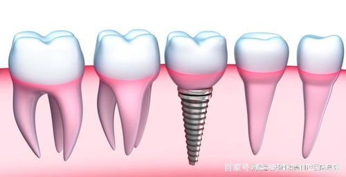 郑州半口种植牙的完整周期解析