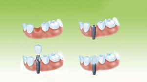 郑州种植牙费用详解及选择指南