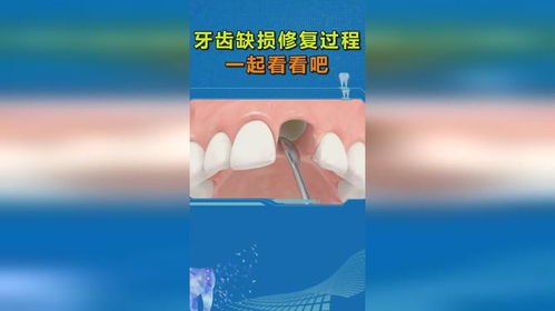 郑州种植牙 牙齿缺损修复过程,一起看看吧
