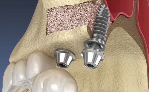 植得口腔陈彦君 多颗 半口 全口缺牙这样种牙更省钱