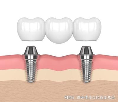 郑州种植牙|缺牙很久了,还有必要种植牙吗?
