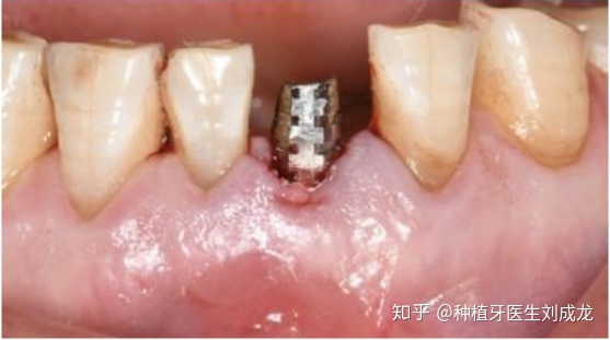 郑州诺贝尔种植牙是啥体验?哪家医院医生种诺贝尔种得好?