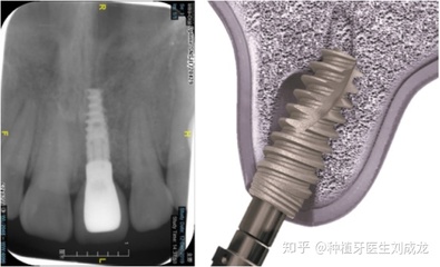 多颗种植牙(郑州)分享