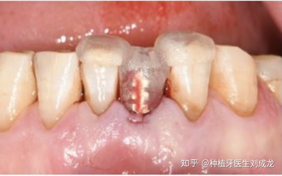 郑州诺贝尔种植牙体验分享与优质医院医生推荐