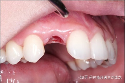 郑州瑞士ITI种植牙 前牙种植修复效果与医师选择的重要性