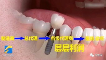 记者暗访济南种牙市场乱象 成本与售价的巨大鸿沟